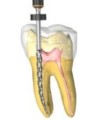 Endodontinis dantų gydymas